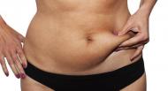 Cellulite : quelles solutions ?